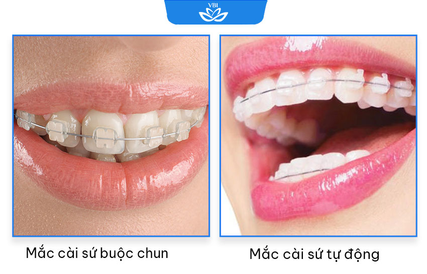 Mâc cài buộc chun và mắc cài tự động