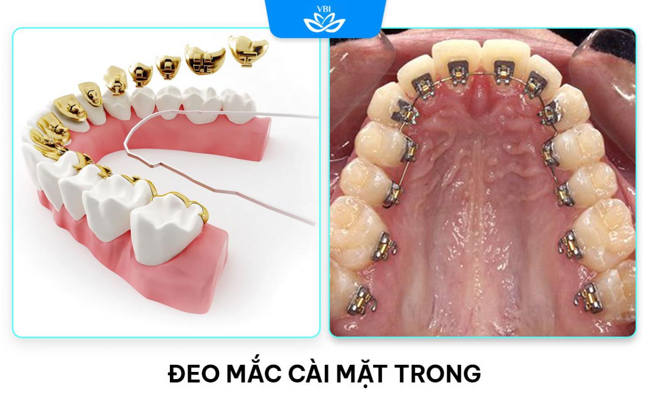 ảnh thực tế đeo mắc cài mặt lưỡi