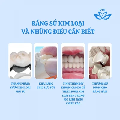 Những điều cần biết về răng sứ kin loại
