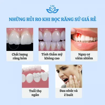Nhung Rui Ro Khi Boc Rang Su Gia Re 1