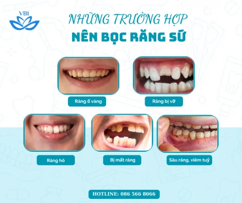 Những trường hơp nên bọc răng sứ