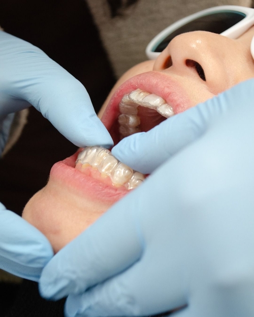 Khay Invisalign trong suốt ôm sát răng