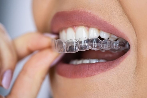 Tháo lắp khay Invisalign dễ dàng