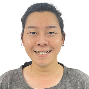 Cao Phi Long - trước niềng
