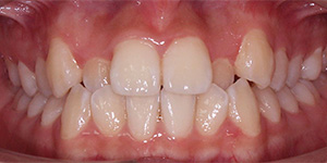 Hàm răng trước niềng - Răng khấp khểnh