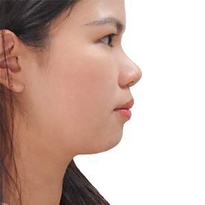 Nguyễn Ngọc Anh (25 tuổi) - sau niềng