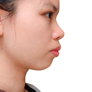 Nguyễn Ngọc Anh (25 tuổi) - trước niềng