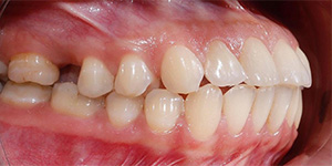 Hàm răng trước niềng - Răng hô, Răng cửa trên – dưới không đạt độ cắn phủ lý tưởng