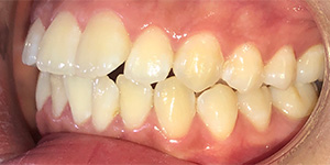 Hàm răng trước niềng - Hô, khấp khểnh