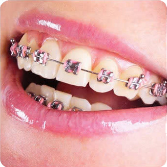 Mắc cài kim loại truyền thống