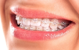 Mắc cài chất lượng cao