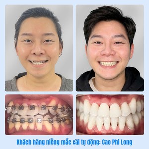 Khách hàng niềng mắc cài tự buộc: Cao Phi Long