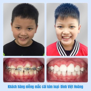 Khách hàng niềng mắc cài kim loại: Đinh Việt Hoàng