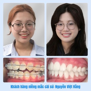 Khách hàng niềng mắc cài sứ: Nguyễn Việt Hằng