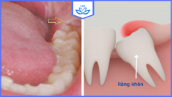 Răng khôn là răng nào