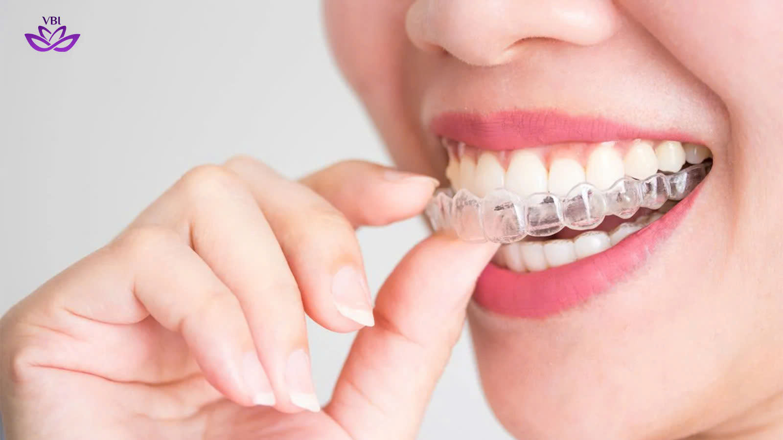 Niềng răng khay trong suốt Invisalign