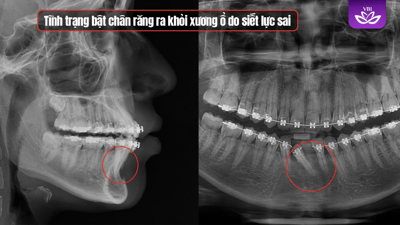 Tác hại niềng răng sai gây bật chân răng trên phim X-quang