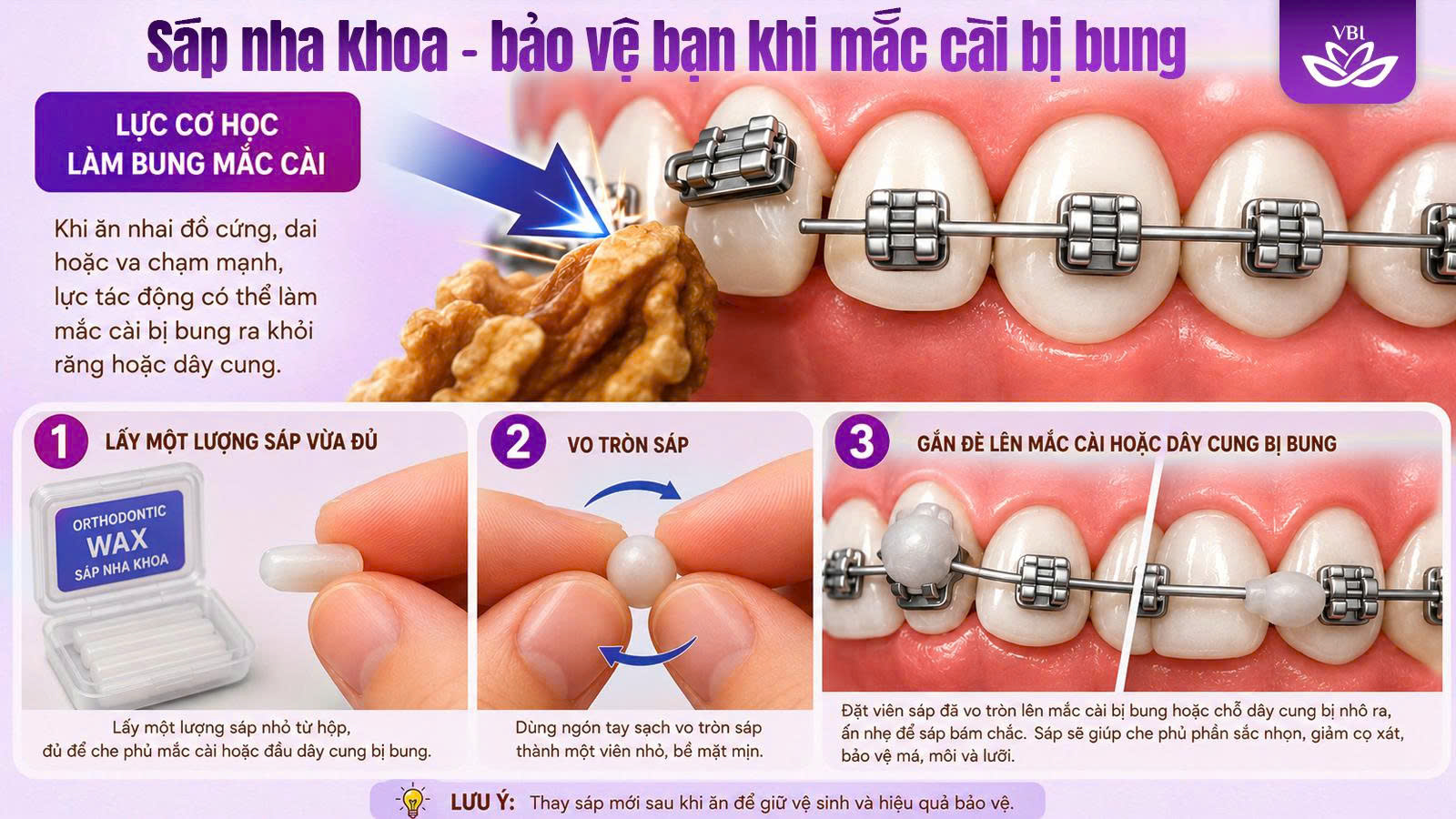 Cách xử lý khi bung mắc cài bằng sáp nha khoa