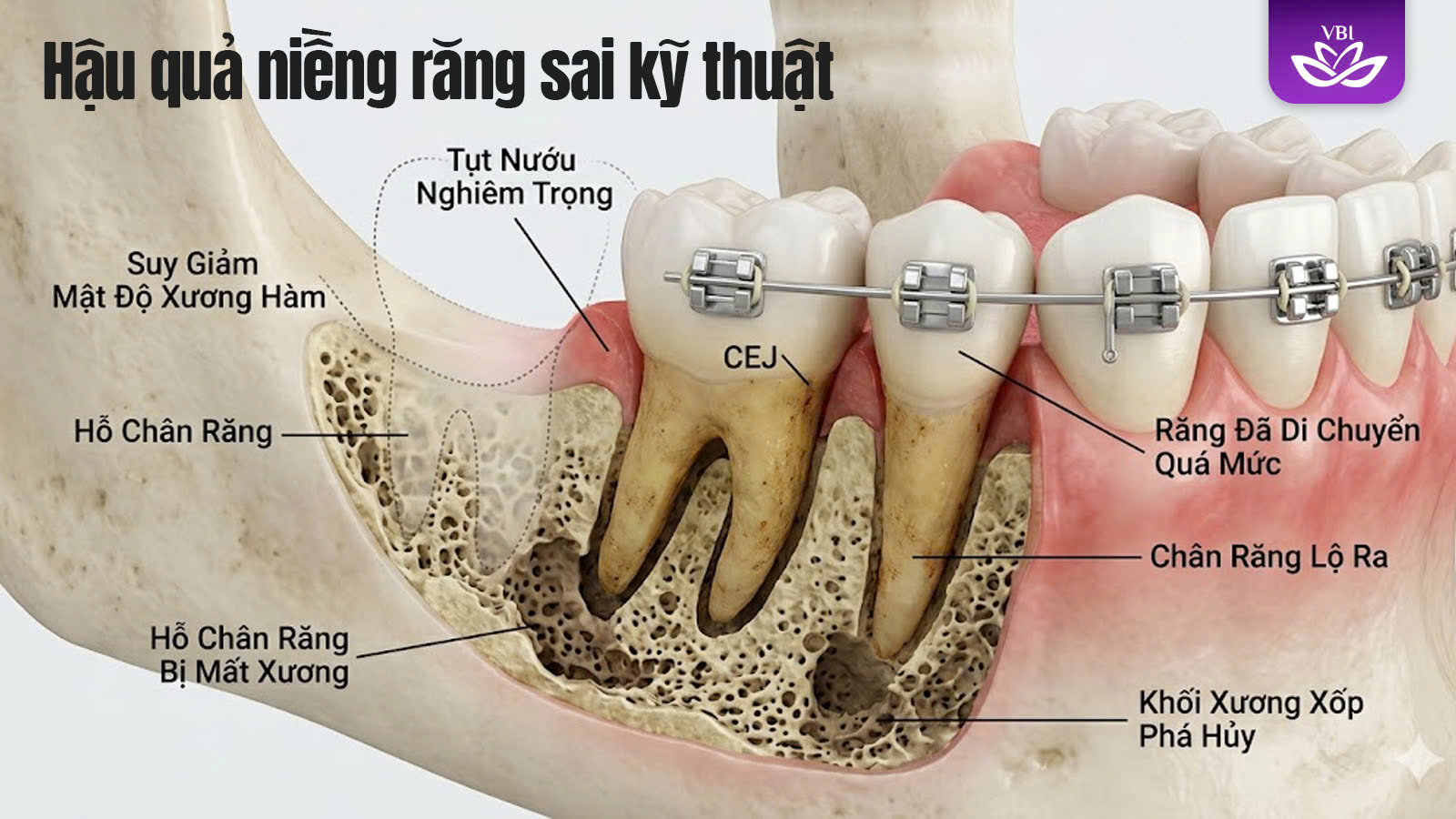Tác hại niềng răng sai gây tiêu xương hàm và tụt nướu