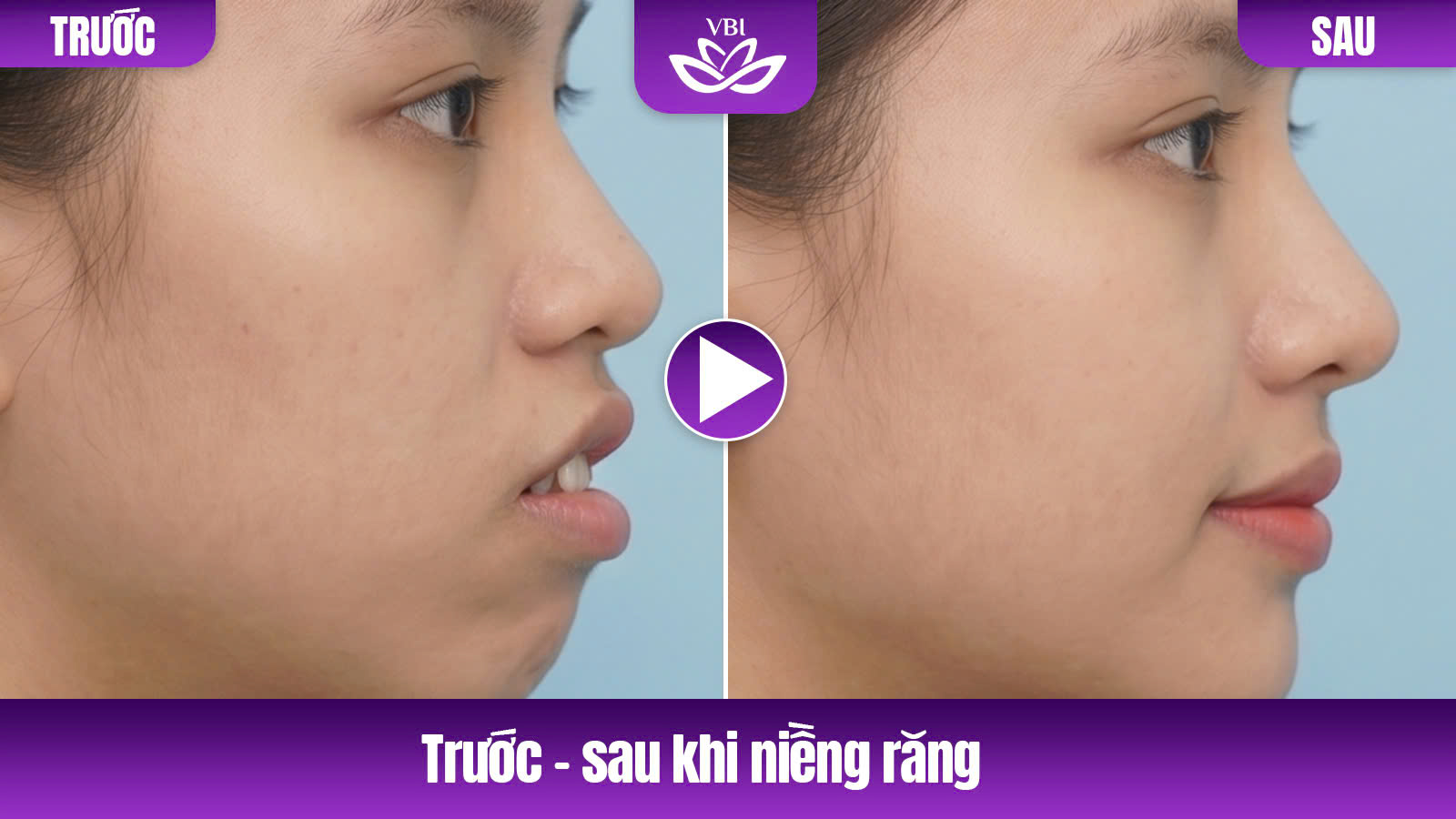 Phân tích góc nghiêng sau khi niềng răng tại Nha khoa Việt Bỉ