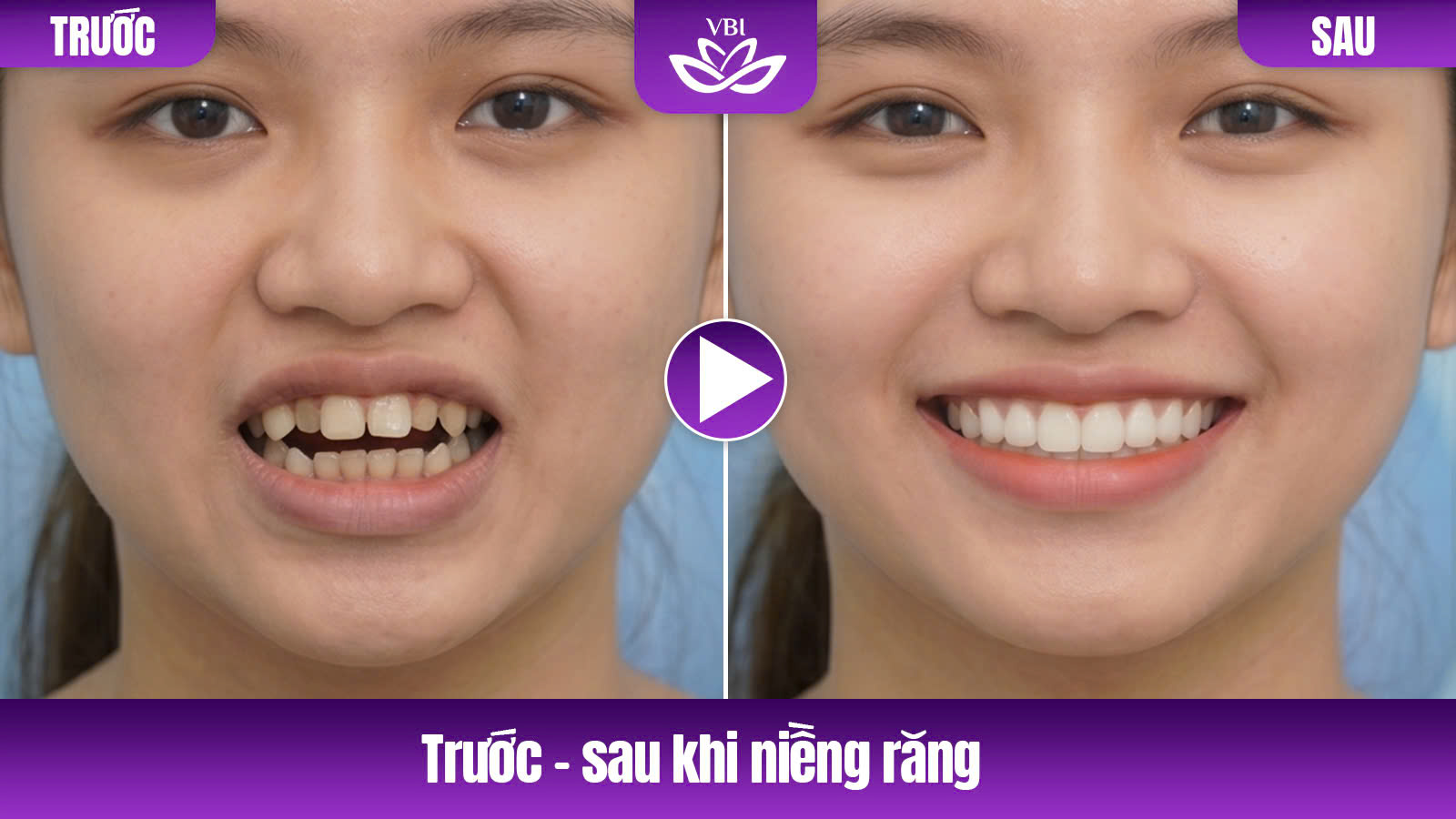 Kết quả trước và sau niềng răng