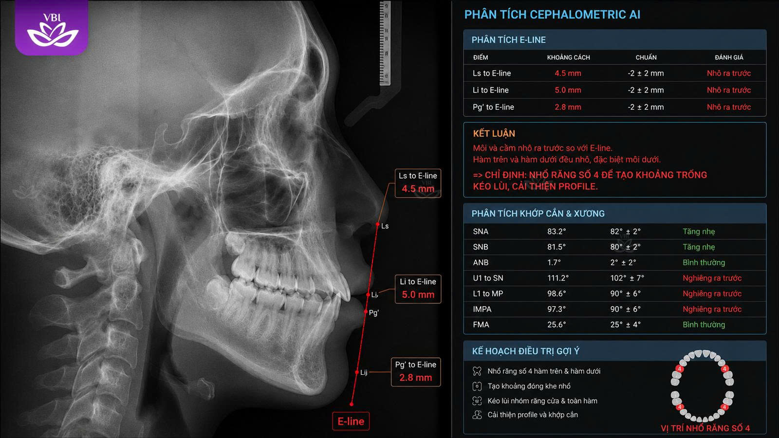 Phim X-quang Cephalometric đánh giá xem niềng răng có phải nhổ răng không
