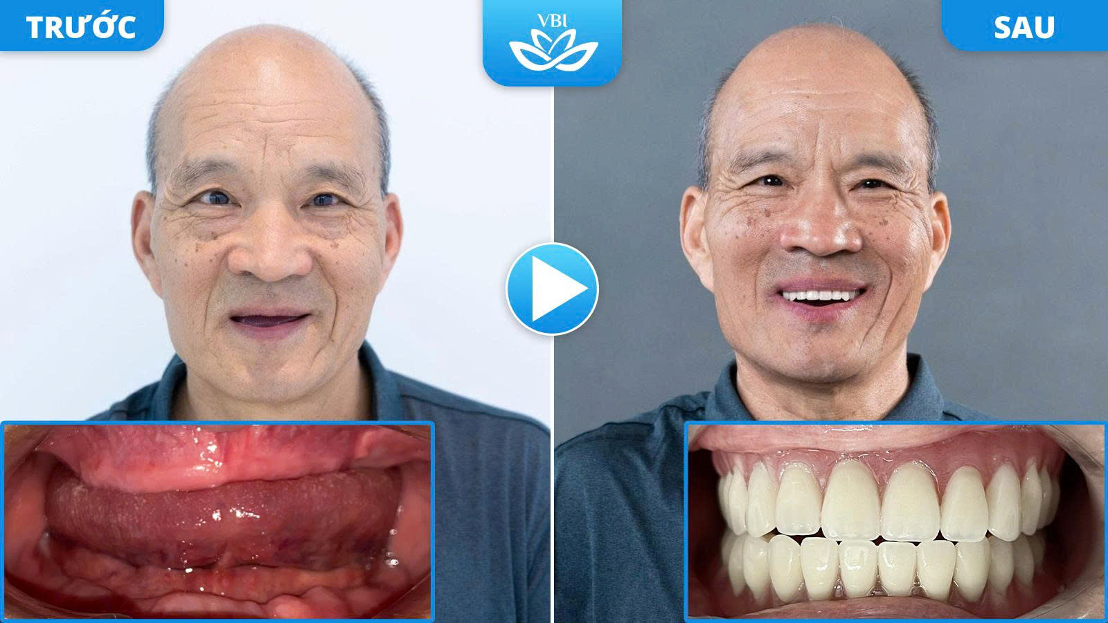 Khách hàng trung niên lấy lại nụ cười rạng rỡ và thẩm mỹ khuôn mặt sau khi trồng răng toàn hàm