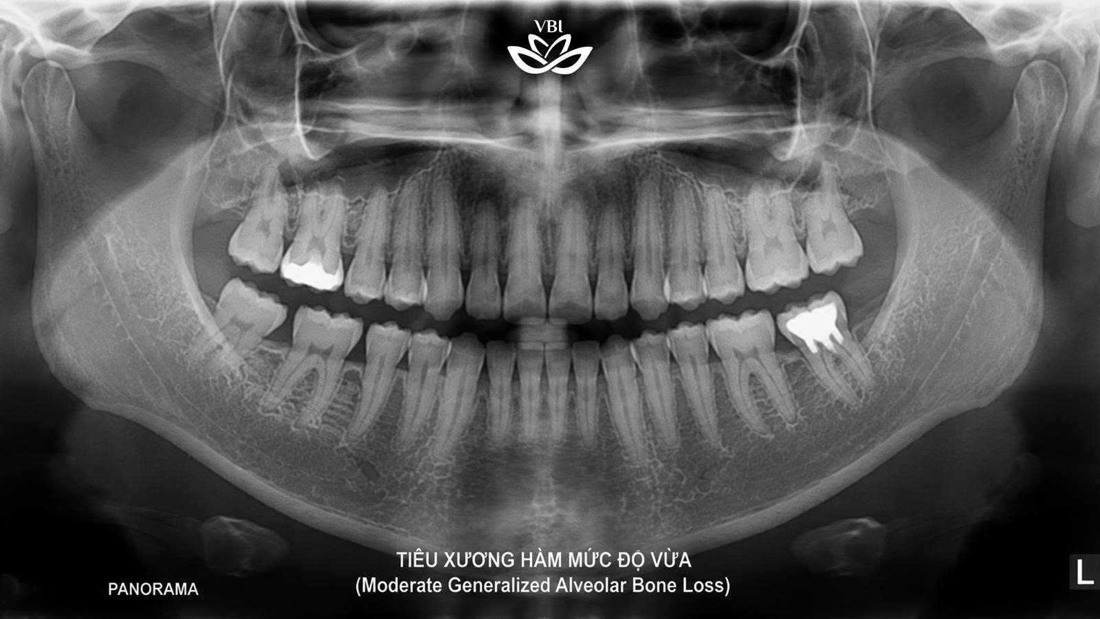 Phim x quang panorama cho thấy tiêu xương hàm rõ rệt sau mất răng