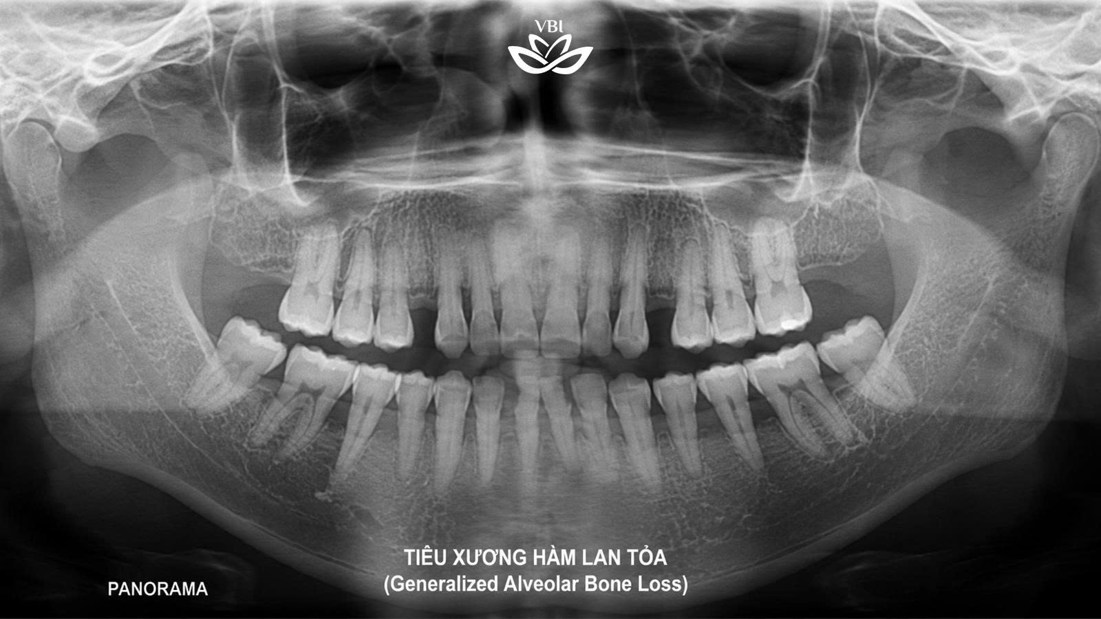 Phim x quang panorama cho thấy tiêu xương hàm rõ rệt sau mất răng