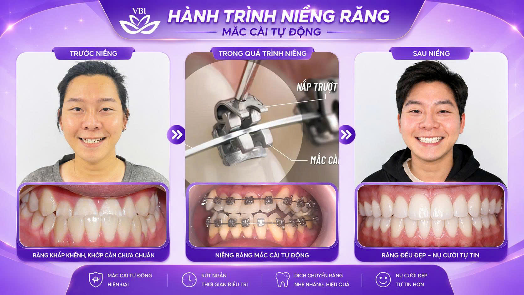Giới văn phòng tự tin giao tiếp với niềng răng mắc cài sứ tự buộc