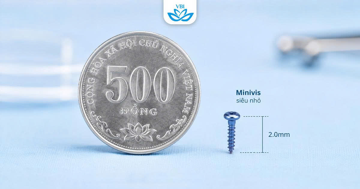 Cắm Minivis Có Đau Không? Giải Mã Sinh Học Ốc Vít Tàng Hình Kéo Lùi Hàm Hô