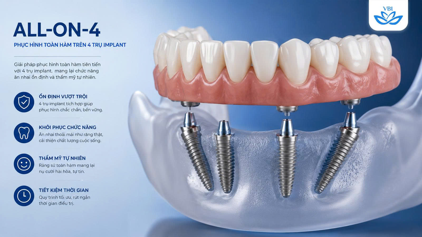 Đồ họa 3D hiển thị nguyên lý cơ sinh học và góc nghiêng 45 độ trong kỹ thuật trồng răng toàn hàm All-on-4