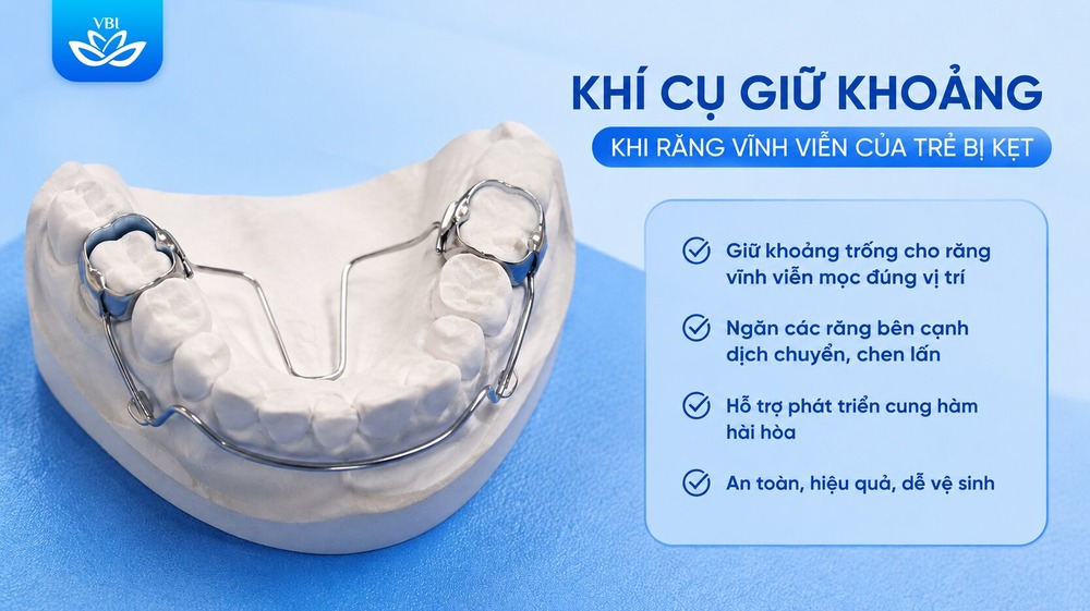 Khí cụ giữ khoảng bảo vệ không gian sau khi rụng răng sữa sớm