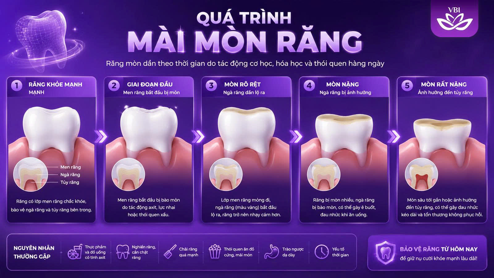 Tác hại mài răng sứ khi làm cầu răng sứ và implant số 7