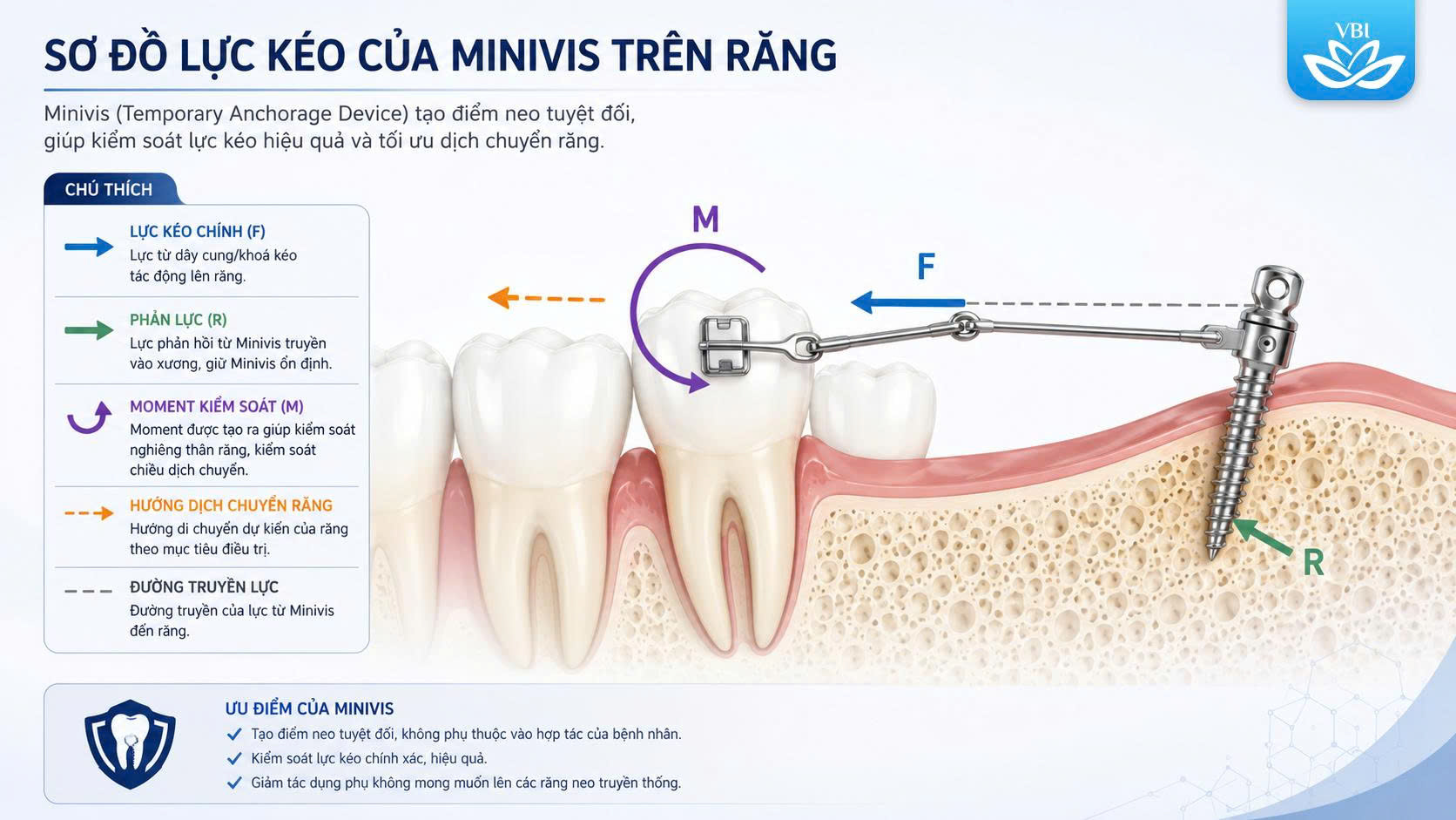 quy trình cắm minivis có đau không khi điều chỉnh vector lực kéo