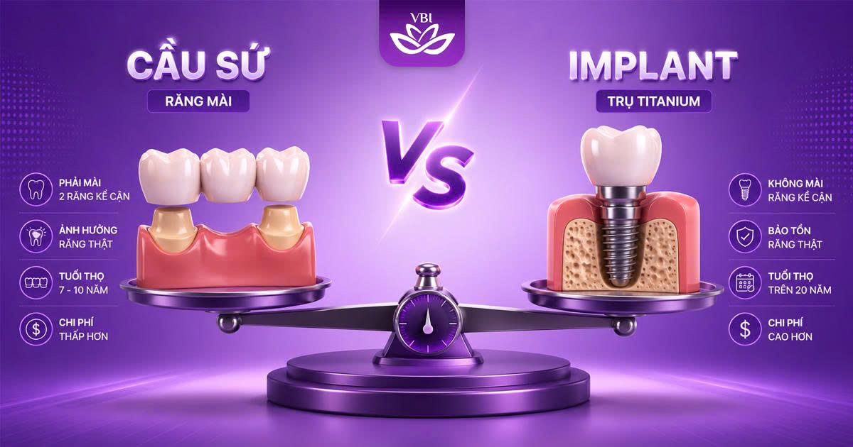 So-sanh-chi-tiet-Cau-rang-su-va-Implant