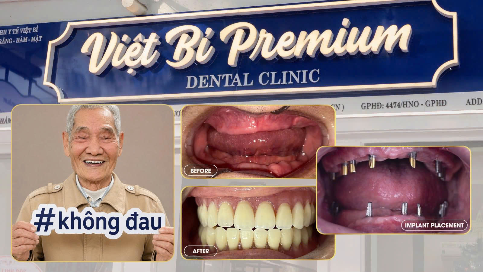Trong-rang-Implant-co-dau-khong_