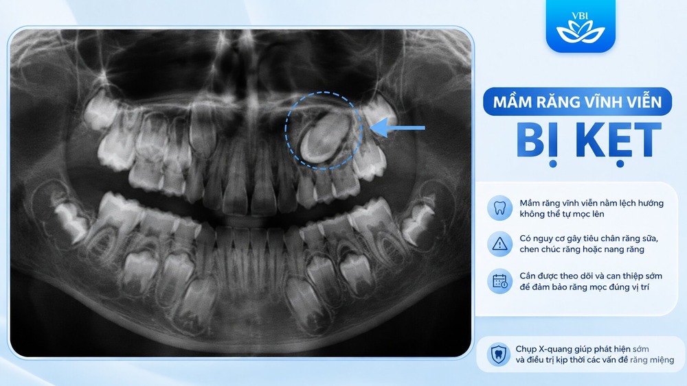 Phim X-quang cho thấy rụng răng sữa sớm khiến mầm răng vĩnh viễn mọc kẹt