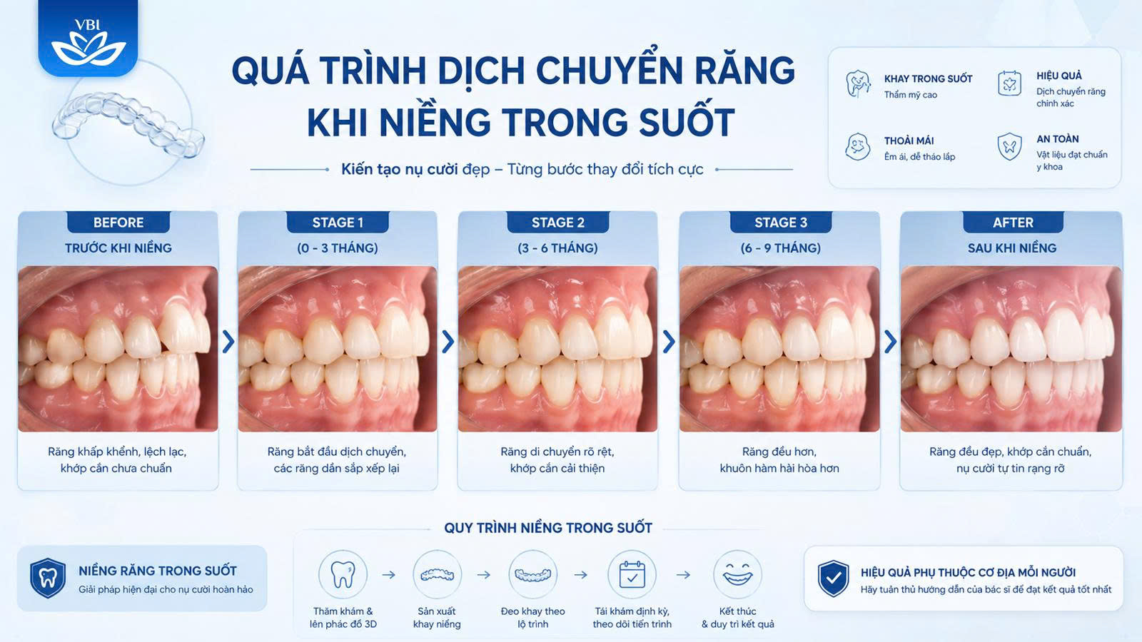 Chuyên gia giải đáp niềng răng trong suốt có hiệu quả không cho tình trạng khấp khểnh