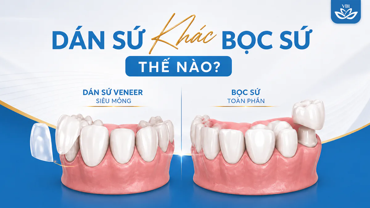 Hình ảnh trực quan so sánh độ mài cùi răng khi bọc răng sứ mài xung quanh và dán veneer bảo tồn răng thật mặt ngoài