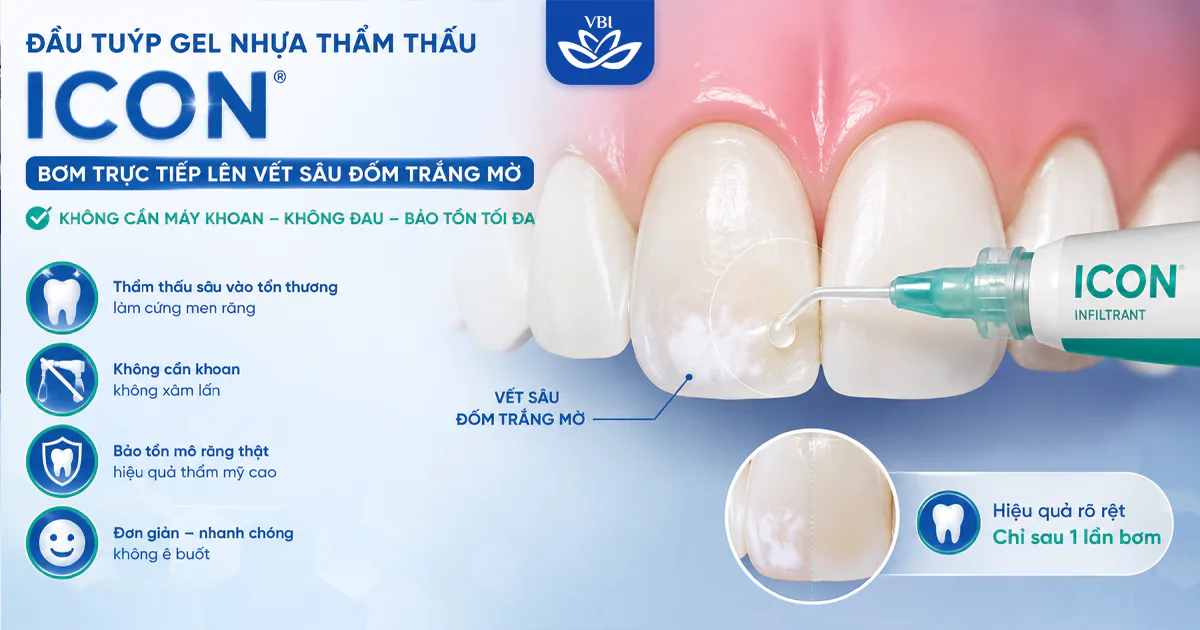 Điều Trị Sâu Răng Sớm Bằng Công Nghệ Icon: Giải Pháp Không Khoan, Không Mài Răng