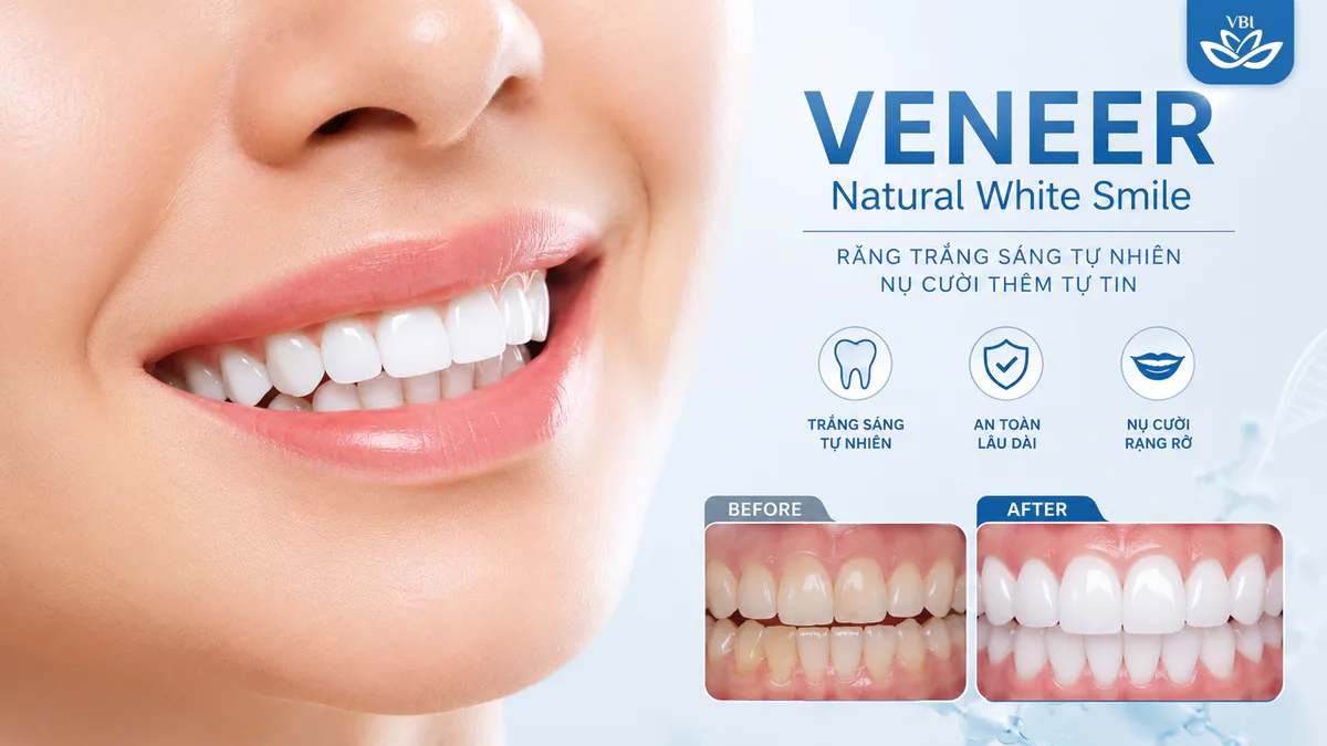 Hàm răng trắng sáng tự nhiên trong trẻo của khách hàng sau khi thực hiện dán veneer bảo tồn răng thật tại Nha khoa Việt Bỉ