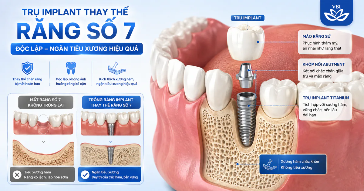 Mất răng số 7 nên làm cầu răng hay Implant? Phân tích từ chuyên gia y khoa