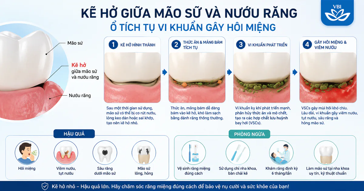 Bọc răng sứ bị hôi miệng: Nguyên nhân gốc rễ và giải pháp khắc phục triệt để