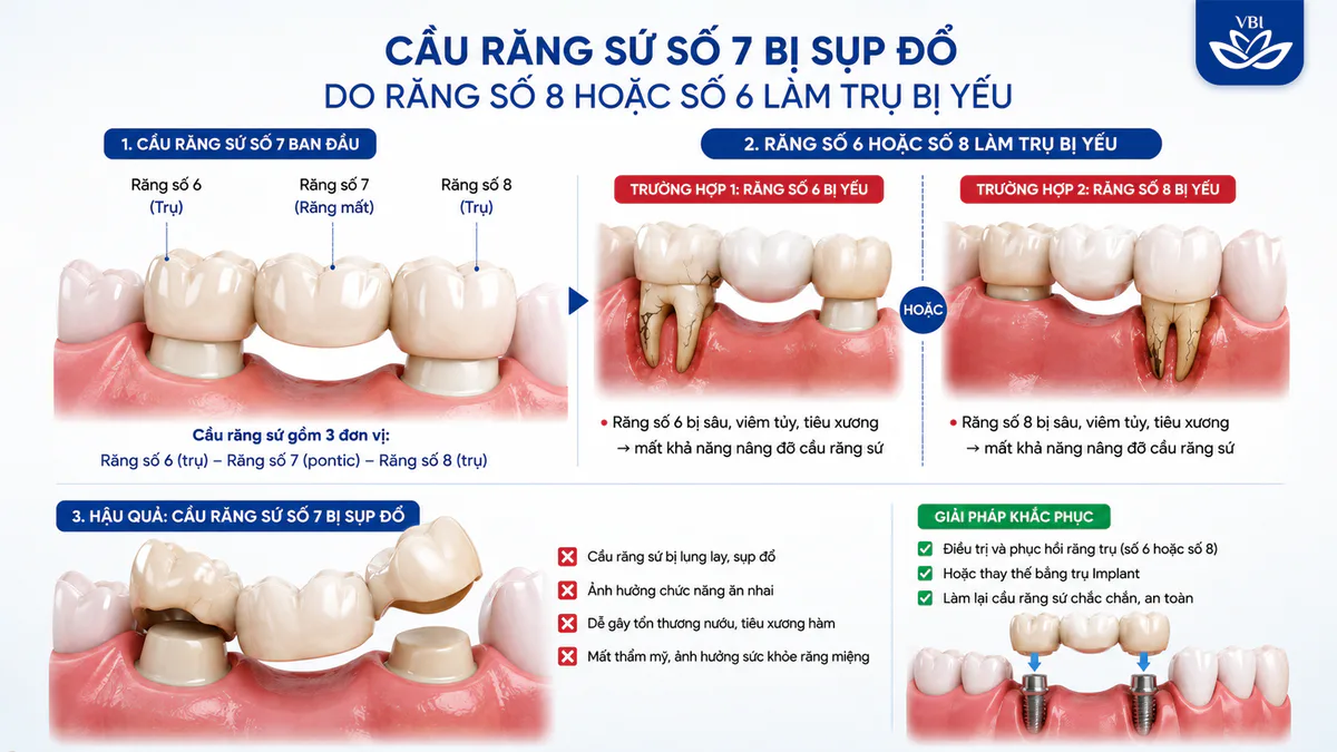 Sơ đồ mô phỏng cầu răng sứ số 7 bị sụp đổ do thiếu mố tựa răng số 8 hoặc do răng số 6 bị quá tải lực nhai