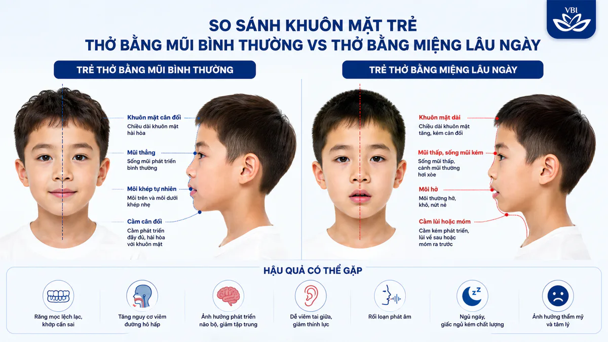 Sơ đồ so sánh cấu trúc khuôn mặt của trẻ thở bằng mũi bình thường và trẻ thở bằng miệng lâu ngày gây móm, hô lệch mặt