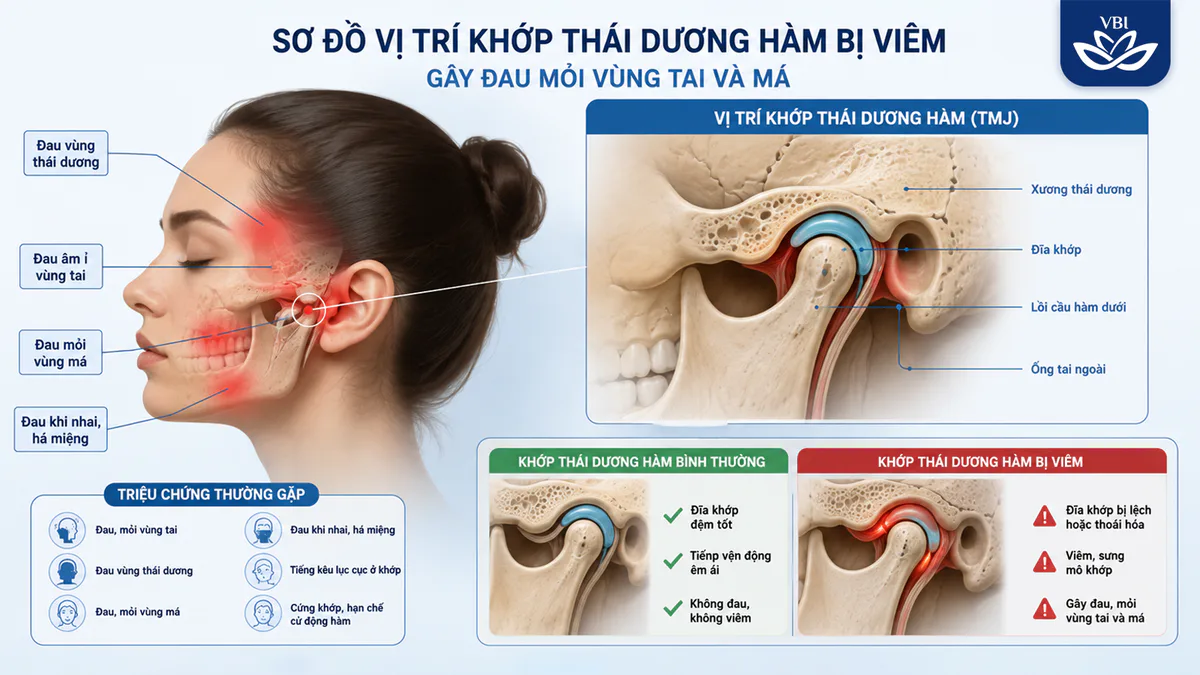 Sơ đồ mô tả vị trí khớp thái dương hàm bị viêm gây đau mỏi dữ dội lan ra vùng tai và má