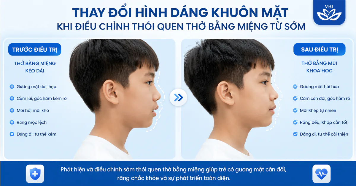 Trẻ thở bằng miệng khi ngủ gây móm, hô lệch mặt: Cảnh báo từ bác sĩ chỉnh nha