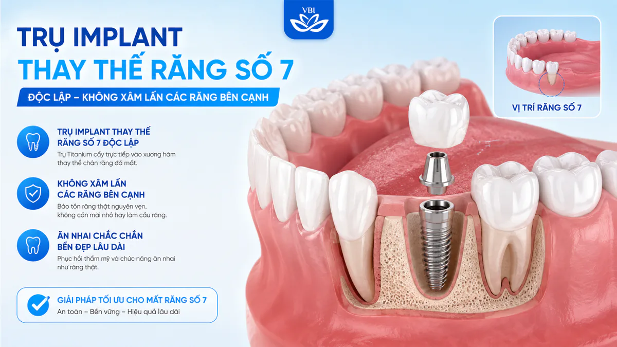 Trụ Implant thay thế độc lập tại vị trí răng số 7 giúp bảo tồn nguyên vẹn răng số 6 và răng khôn bên cạnh