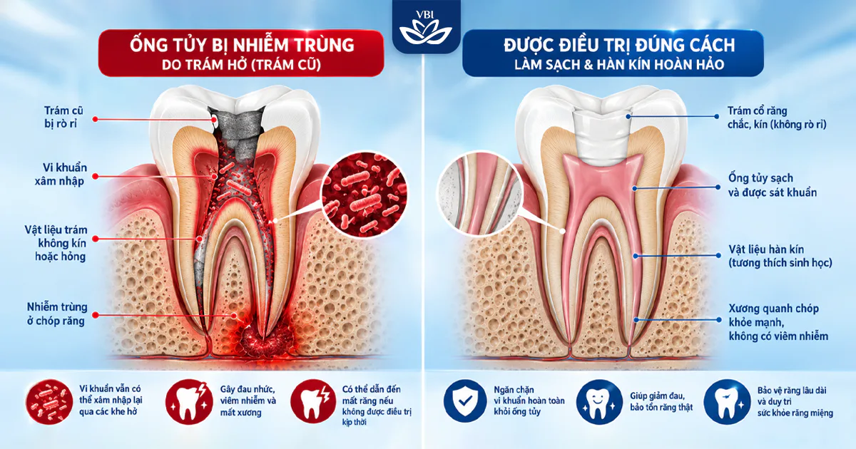 Tủy Răng Đã Xử Lý Lại: Giải Pháp Cứu Cánh Cho Răng Điều Trị Hỏng